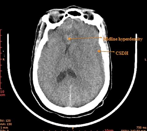 Preoperative Computed Tomography Download Scientific Diagram