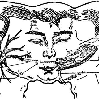 Schematic representation of insertion of one-stage free gracilis flap ...