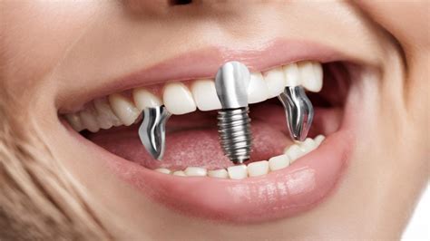 Dental Implants Which Option Is Best For You Are You Ready To