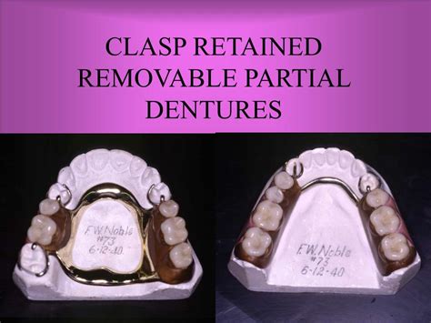 Ppt Clasp Retained Removable Partial Dentures Powerpoint Presentation Id3650847