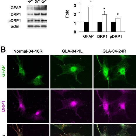 Upregulation Of Drp And Pdrp Protein Expression In Glaucomatous Human