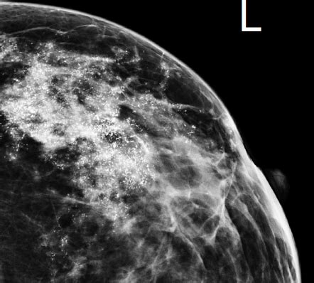 Breast Calcifications Radiology Reference Article Radiopaedia Org