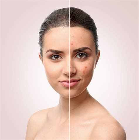 Acne — Petrin Dermatology