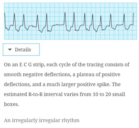 Ch 7 Sotos Waveforms Rate Rhythm And Artifacts Flashcards Quizlet