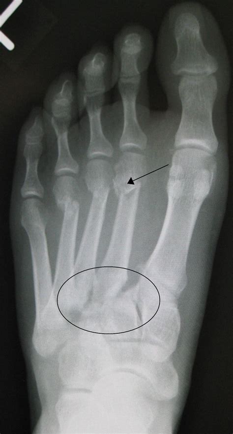 Lizfranc Injuries Lisfranc Injury Radiology X Ray