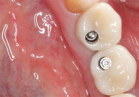 Resolving a Common Implant Complication: Creating Attached Gingiva ...