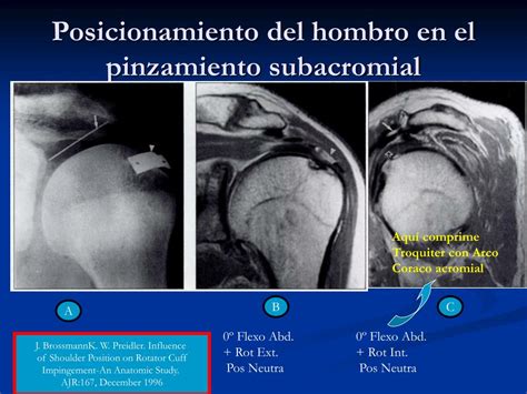 Ppt Rehabilitaci N De Hombro Y S Ndrome Del Pinzamiento Subacromial