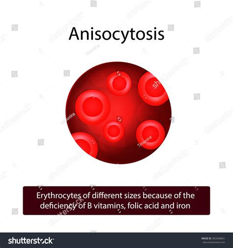 Anisocytosis Red Blood Cells Different Sizes Stock Vector (Royalty Free ...