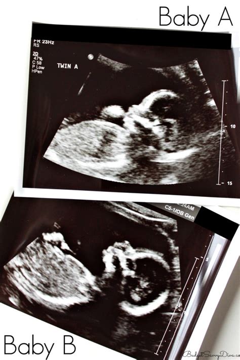 Identical Twins Ultrasound 20 Weeks