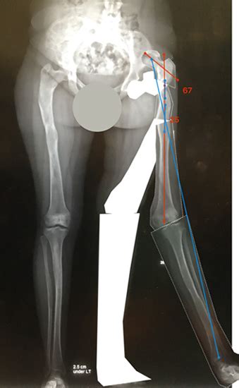 Fibrous Dysplasia International Center For Limb Lengthening