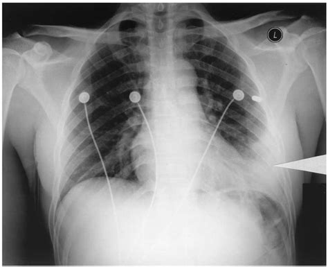 Chest X-ray showing pulmonary contusion (arrowhead). | Download Scientific Diagram