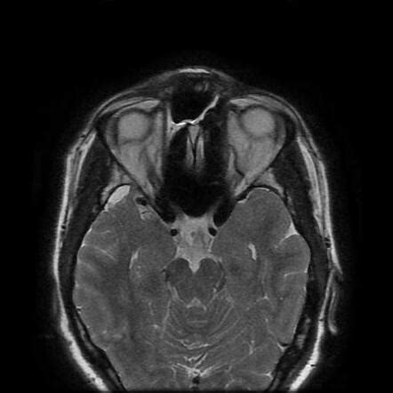 Optic neuritis | Radiology Case | Radiopaedia.org