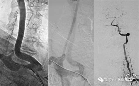 锁骨下动脉盗血综合征 脑医汇 神外资讯 神介资讯