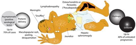 Children Free Full Text Congenital Syphilis—an Illustrative Review