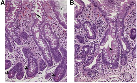 Figure 1 From Histologic Subtyping Of Gastric Intestinal Metaplasia