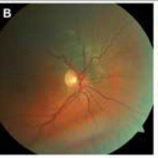 Fundus Photographs Of Patients With Uveal Melanoma In The Macula A