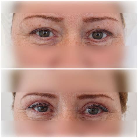 Blefaroplastie Clinica Estetica Dr Morad Iancu