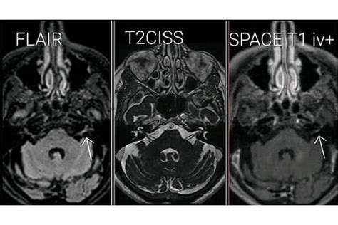 Paralysie faciale périphérique a frigore bell s palsy CIMOP