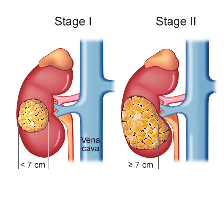 Top-Rated Kidney Cancer Surgery in Ahmedabad: Choose the Best Surgical Care