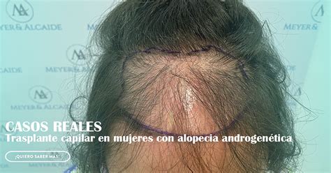 Trasplante capilar y Alopecia Androgenética en la mujer Meyer Alcaide