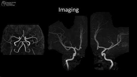 Young child with acute left hemiparesis after minor trauma | American ...