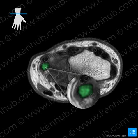 Mri Axial Labeled Wrist Anatomy