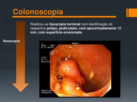 PPT Invaginação Intestinal de Pólipo Fibróide Inflamatório do Íleon