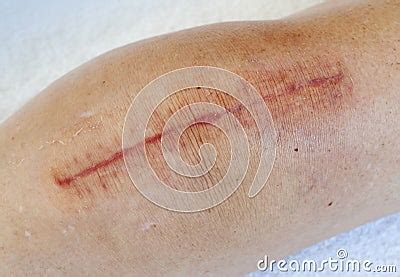 Scar From Knee Surgery Stock Images - Image: 14577554