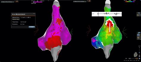 Left Electroanatomical map showing a small area 1 3 cm² of