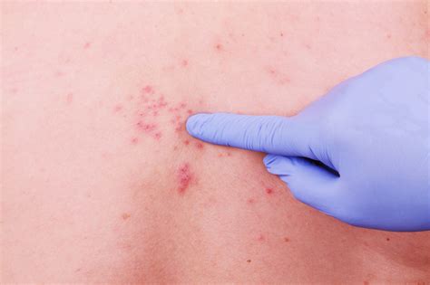 Viral Dermatitis | Symptoms & Treatment | We Prescribe