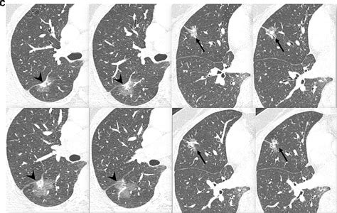 A Novel Algorithm To Differentiate Between Multiple Primary Lung