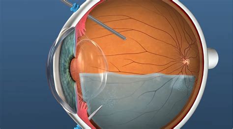 Ppv Cross Section 2 Retina Doctor