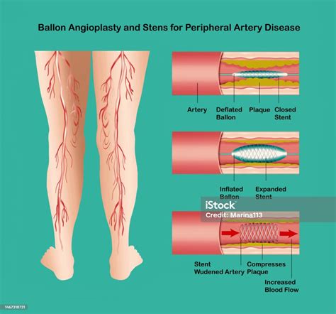 Diagram Showing Angioplasty For Peripheral Artery Disease Illustration