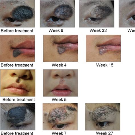 Congenital Melanocytic Nevus Cmn Clinical Appearance Before Week 0