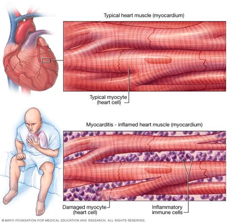 Miocarditis Síntomas Y Causas Mayo Clinic