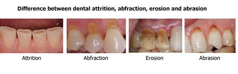 Tooth Abfraction Treatment