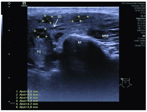 A Case Of Chronic Recurrent Parotitis With Sialectatic Sialodochitis Is