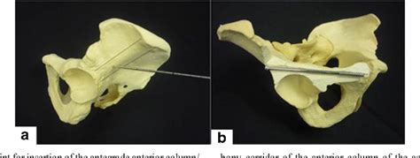 The Obturator Oblique And Iliac Oblique Outlet Views Predict Most