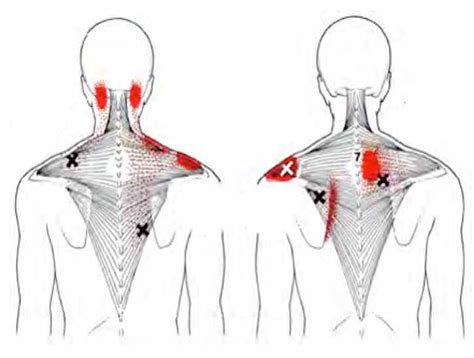 Dry Needling Everything You Need To Know