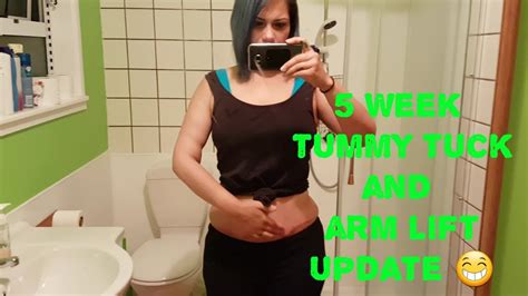 5 Week Tummy Tuck And Arm Lift Update Youtube