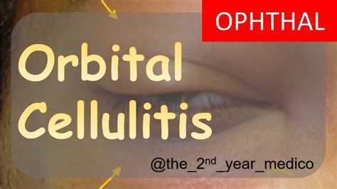 Orbital Cellulitis Clearly Explained Ophthalmology Mbbs Dr Qwerty Youtube