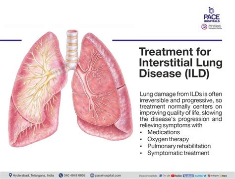 Interstitial Lung Disease Causes, Symptoms And Treatment, 55% OFF