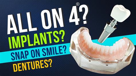 Know This About All On 4 Vs Snap On Smile Vs Dentures YouTube