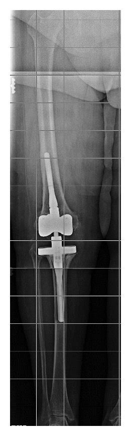 Hinged Revision Total Knee Arthroplasty After Second Stage Replacement