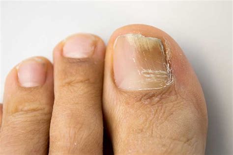 Fungal Nail Infections Ausmed