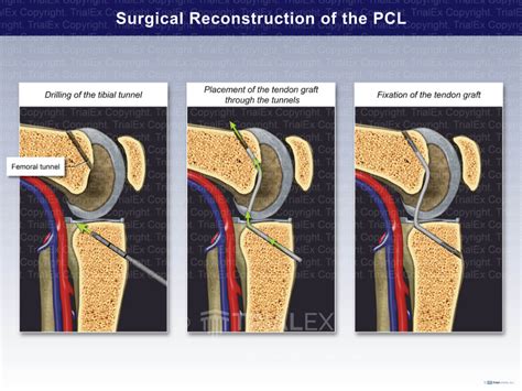 Surgical Reconstruction of the PCL - TrialExhibits Inc.