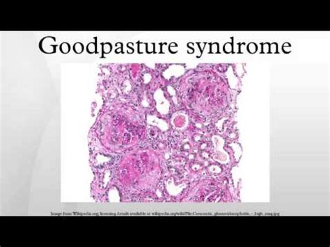 Goodpasture syndrome - YouTube