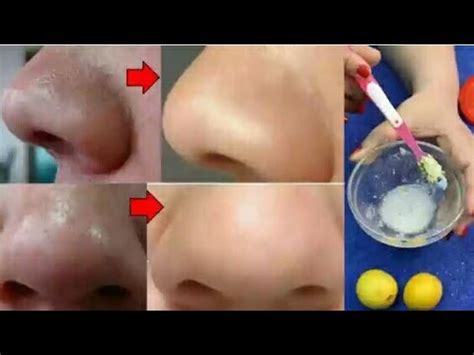 How To Remove Tons Of Blackheads And Whiteheads Instantly Youtube