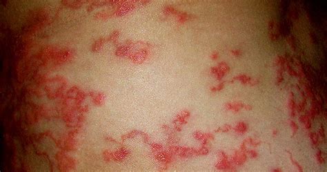 Life Changing Health News: Common Infection Often Misdiagnosed In ...