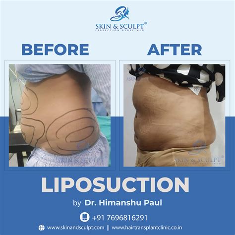 Liposuction In Chandigarh Guide